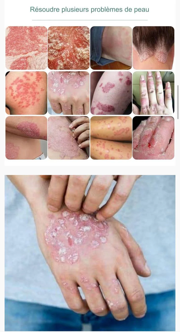 Eczéma-Kins Image 2